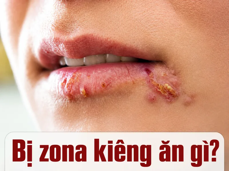 Người bị zona nên duy trì chế độ ăn cân đối và tuân thủ điều trị thay vì kiêng khem quá mức.